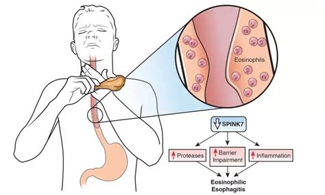 Elimination Diets Show Similar Histologic And Endoscopic Outcome In Eosinophilic Esophagitis