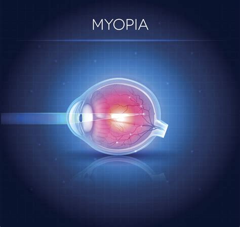 Why Is Myopia Management Important Review Of Myopia Management