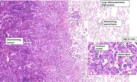 Lung Bronchogenic Carcinoma Nus Pathweb Nus Pathweb