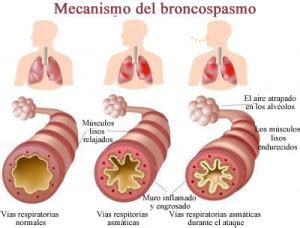 Broncoespasmo O Que É