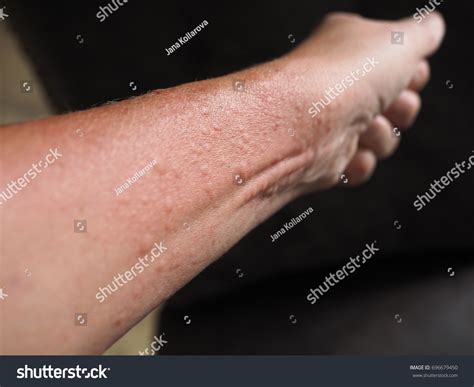 Symptoms Contact Allergy On Hands Skin Stock Photo 696679450 | Shutterstock