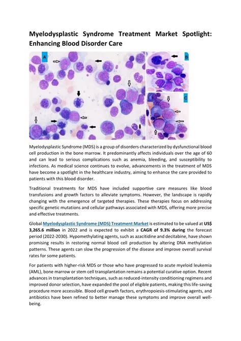 PPT - pdf Myelodysplastic Syndrome Treatment Market Spotlight PowerPoint Presentation - ID:12410228