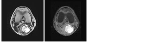 Radiological Mimics Of Popliteal Cysts An Algorithmic Approach Using