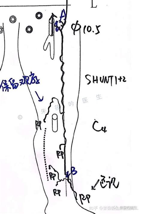 朱筱吟医生 简约但不简单：chiva手术精准治疗下肢静脉曲张 知乎