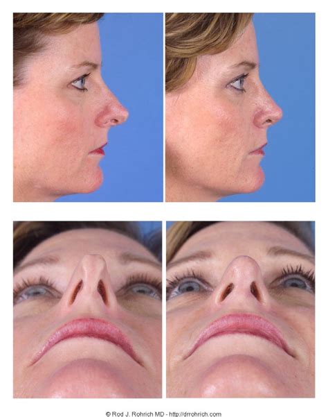 Revision Rhinoplasty Before And After Photos