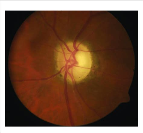 Optic Atrophy With Apparent Cupping After Resolution Of Acute Aaion