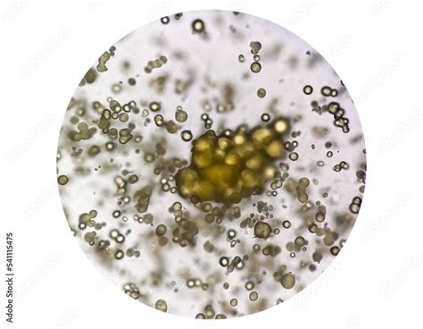 Microscopic image of Urinalysis. Abnormal urine exam. Uric acid crystals. Stock Photo | Adobe Stock