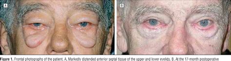 Figure 1 From Severe Periorbital Edema Secondary To Imatinib Mesylate