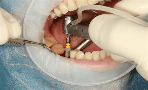 A Guide to Dental Implants Procedure - Dental Implants