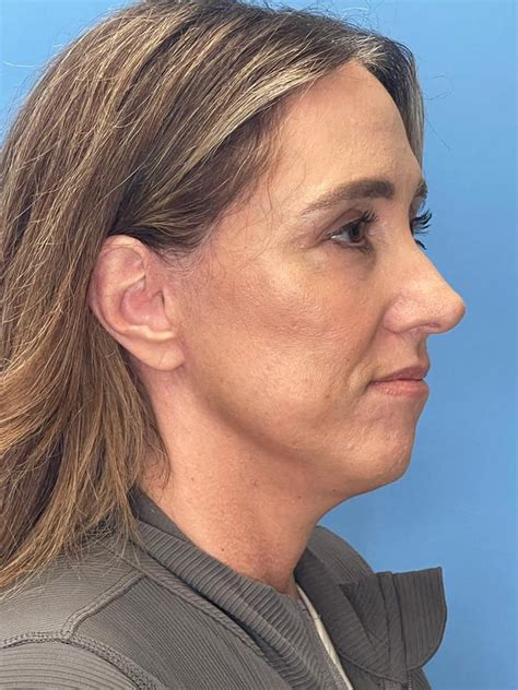 Laser Skin Resurfacing Before And Afters Ocss