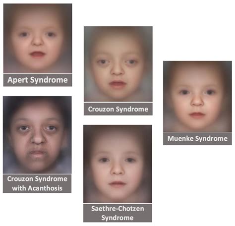 Craniosynostoses And Craniofacial Conditions Discoveries In The Year Of