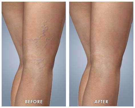 Varicose And Spider Vein Treatment Pinellas Vascular