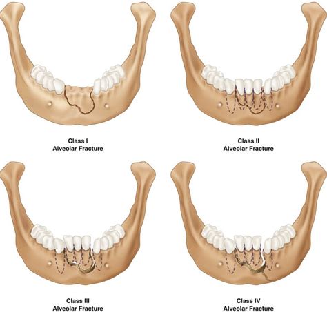 Alveolar Fracture News Dentagama