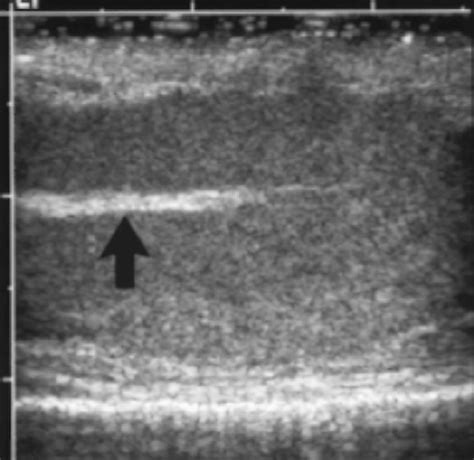 Scrotal Ultrasound Radiology Key