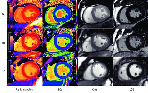 Comparison Of Native T1 Ecv Cine And Lge Images Among Patients With