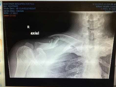 broken collar bone, surgery or no?- Mtbr.com