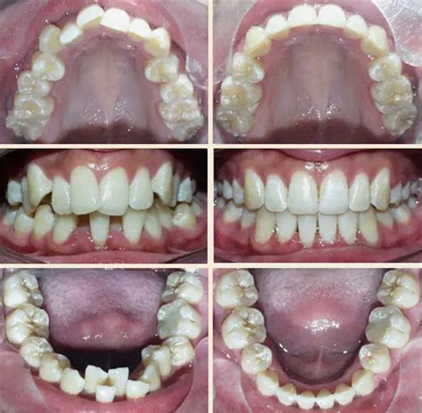 Before & After Photos | Straightly Orthodontics - Davie, FL