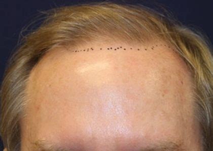 Patient Hair Restoration Before And After Photos La Jolla