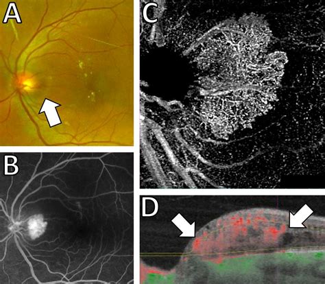 Diagnosing Exophytic Retinal Capillary Hemangioblastoma Retina Today