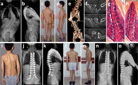 Sacral Agenesis Evaluation Of Accompanying Pathologies In 38 Cases