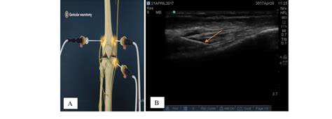 Radiofrequency Ablation Of Genicular Nerves A Three Genicular Nerve Download Scientific Diagram