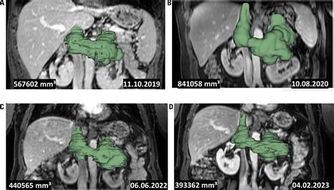 Stereotactic radiotherapy as a valuable therapeutic procedure for ...