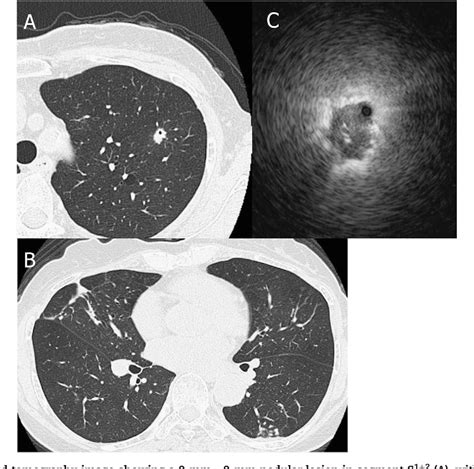 Figure 1 From Endobronchial Ultrasound Guided Transbronchial Biopsy