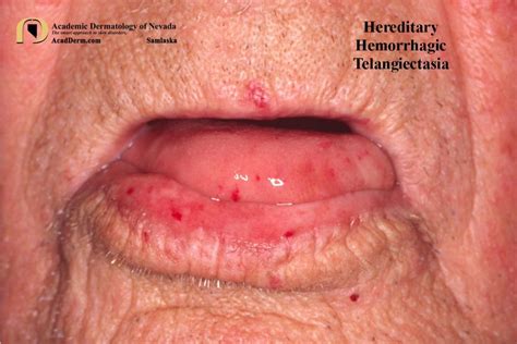 Hereditary Hemorrhagic Telangiectasia Osler Weber Rendu Academic