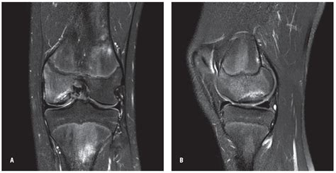 Osteochondritis Dissecans Of The Knee Differential Diagnosis