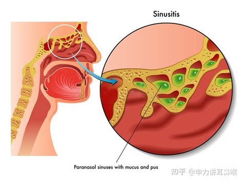 患有鼻炎会引起打鼾吗？ 知乎