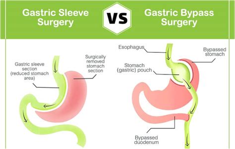 Gastric Bypass Vs Gastric Sleeve Which One Is Right For You Fitness