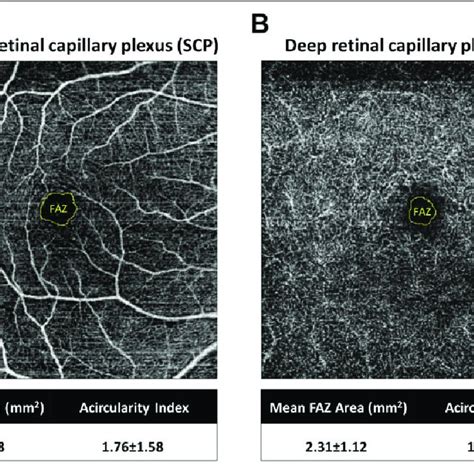 Regression Analysis For The Foveal Avascular Zone Of The Superficial Download Scientific