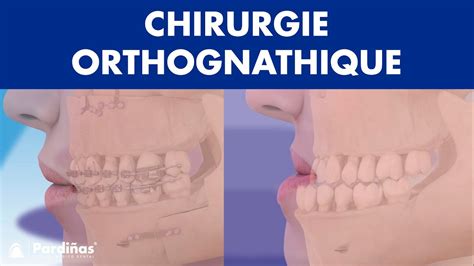 Chirurgie Orthognathique Op Ration De La Machoire Pour Corriger Sa