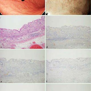 Undifferentiated Early Adenocarcinoma With Gastric Phenotype As One Of