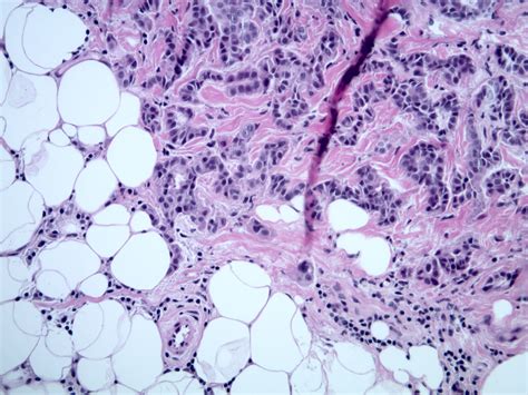 Epithelioid Mesothelioma Infiltrating Into Adipose Tissue Kiko Xp