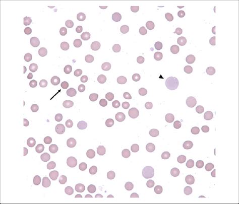 Peripheral Blood Smear Giemsa Â100 Is Remarkable For Many