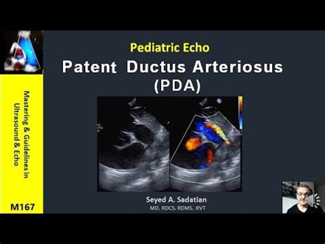 Pediatric Echo Patent Ductus Arteriosus Pda Youtube