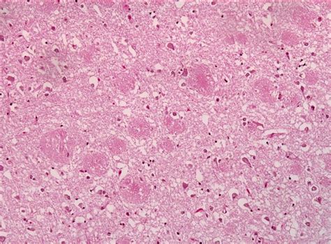 Alzheimer’s Update: Researchers Find Link Between Beta-Amyloid And ...