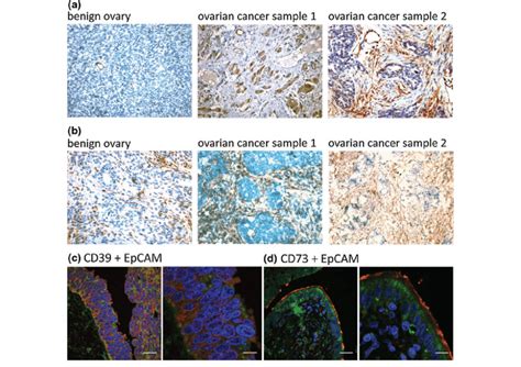 Immunohistochemical Analysis Of Cd And Cd Expression In Ovca