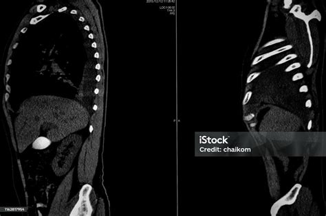 Computer Tomography Angiography Cta Of Whole Body Scan With 3d Reconstruction Ct Angiography For