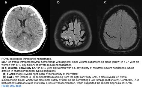 Cerebrovascular Dysregulation Posterior Reversible Encephalopathy Syndrome And Reversible