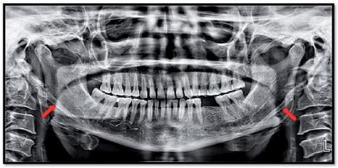 Panoramic Radiograph Revealing The Length Of The Styloid Processes