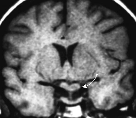 Lesions Of The Hypothalamus MR Imaging Diagnostic Features RadioGraphics