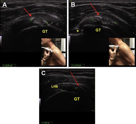 Arthroscopic Ultrasound Guided Needling An Effective Technique For The