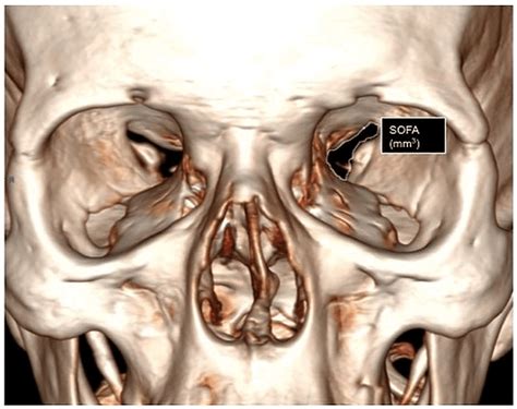 D Ct Reconstruction Measurements Of The Superior Orbital Fissure Area