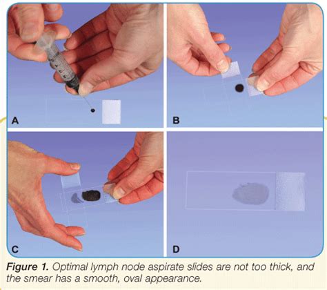 Lymph Fluid Sample