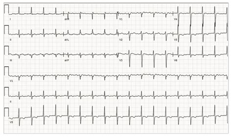 Novel High Density Mapping Techniques For Atypical Atrial Flutter