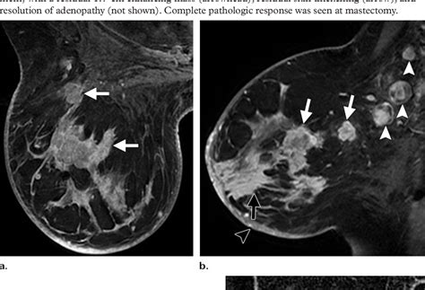 What Radiologists Need To Know About Diagnosis And Treatment Of Inflammatory Breast Cancer A