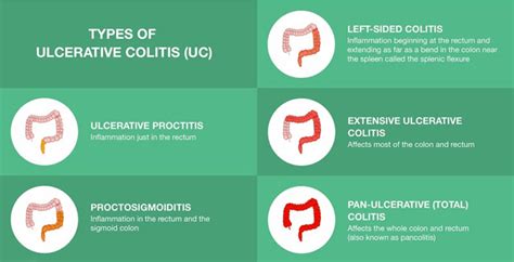 Is Ulcerative Colitis Genetic Decode Your Dna And Learn Your Risks