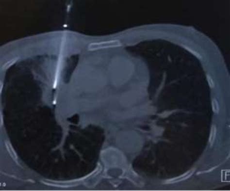 Table 1 From Diagnostic Yield Of Percutaneous Computed Tomography Guided Core Needle Biopsy Of